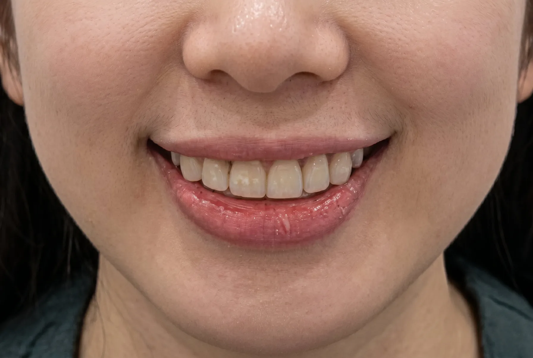 Smile Makeover - After